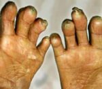 सुदूरपश्चिममा कुष्ठरोग नियन्त्रणमा चुनौती, नयाँ बिरामी बढ्दै