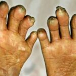 सुदूरपश्चिममा कुष्ठरोग नियन्त्रणमा चुनौती, नयाँ बिरामी बढ्दै