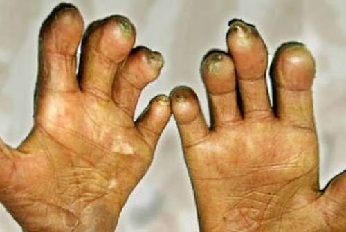 सुदूरपश्चिममा कुष्ठरोग नियन्त्रणमा चुनौती, नयाँ बिरामी बढ्दै