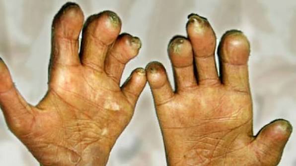 सुदूरपश्चिममा कुष्ठरोग नियन्त्रणमा चुनौती, नयाँ बिरामी बढ्दै